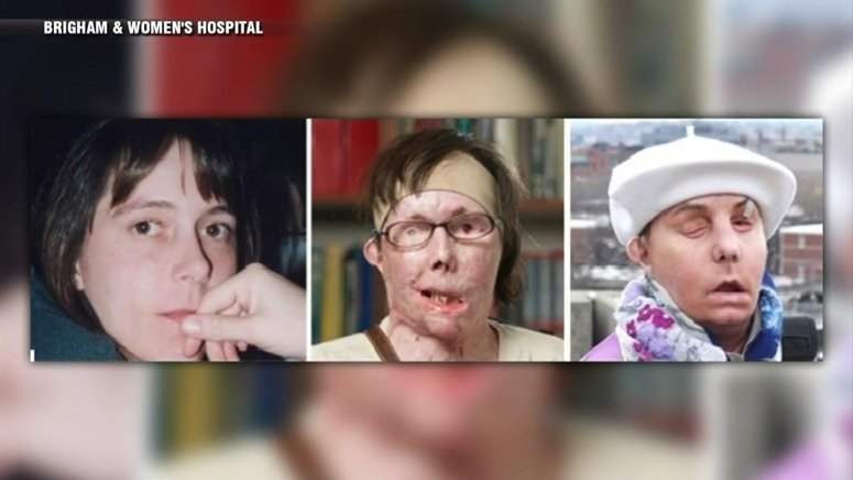 Face Transplant Recipient S Donor Face Now Failing Boston News Weather Sports Whdh 7news A woman whose brother was killed in a car accident has met the man who was given his face, in a pioneering transplant operation. face transplant recipient s donor face