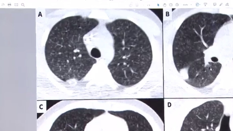 Teen in Canada develops 'popcorn lung' symptoms after vaping flavored e-liquids and THC - Boston News, Weather, Sports | WHDH 7News Teen in Canada develops 'popcorn lung' symptoms after vaping flavored e-liquids and THC - Boston News, Weather, Sports | WHDH 7News