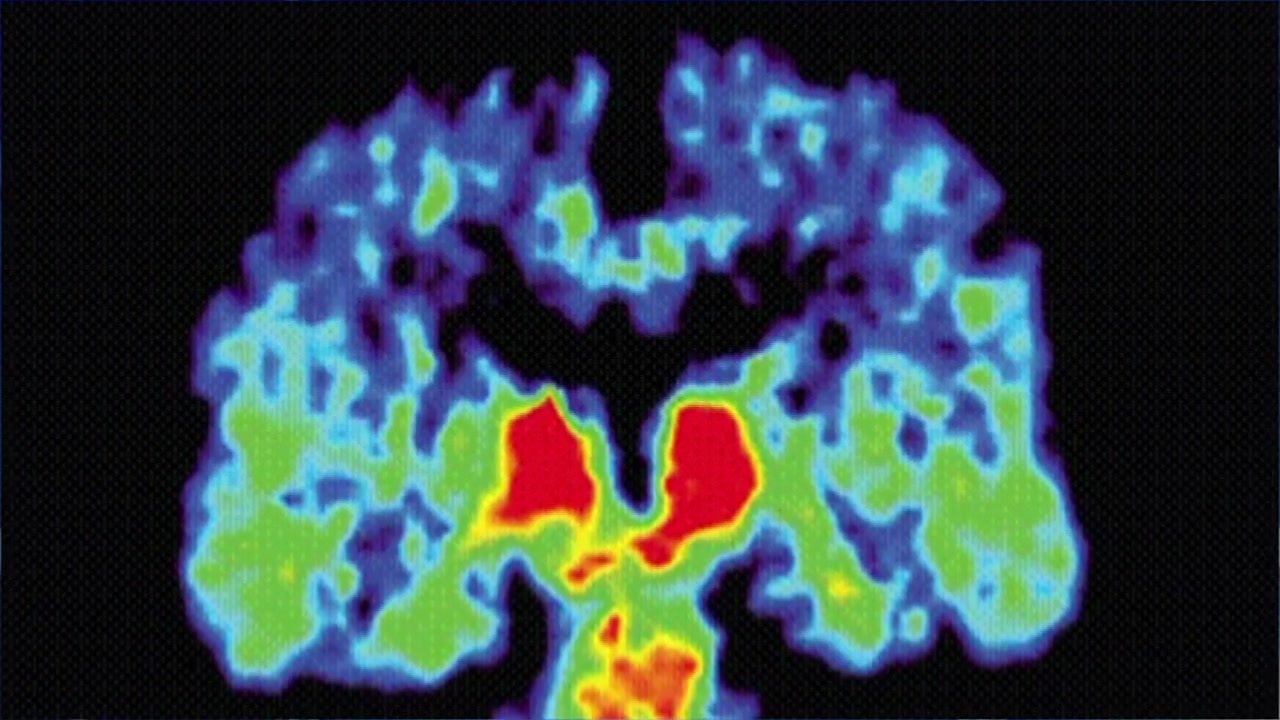 Researchers at BU hoping results from recent CTE study will help lead