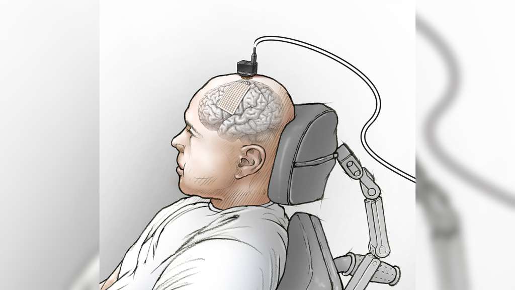 Man Speech Implant