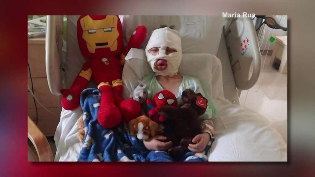 Family: Injured boy screamed ‘Mommy, they lit me on fire’ – Boston News, Weather, Sports