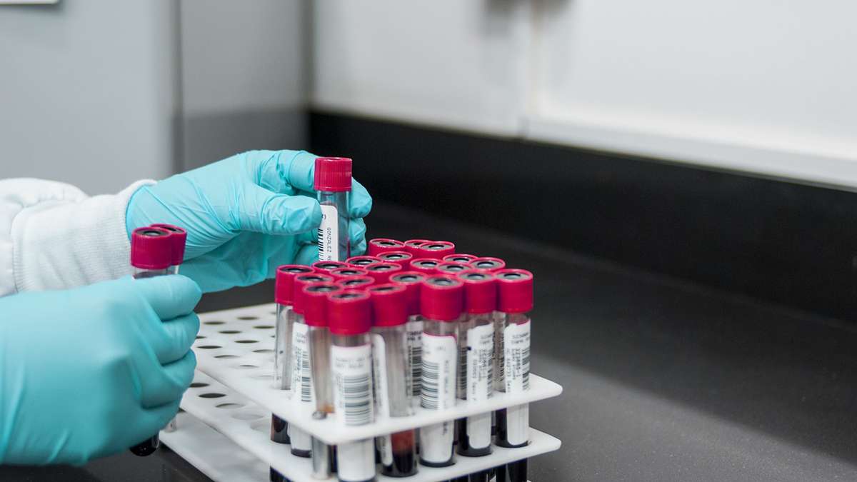 A blood test for colon cancer performed well in a study, expanding options for screening - Boston News, Weather, Sports - Vimarsana News