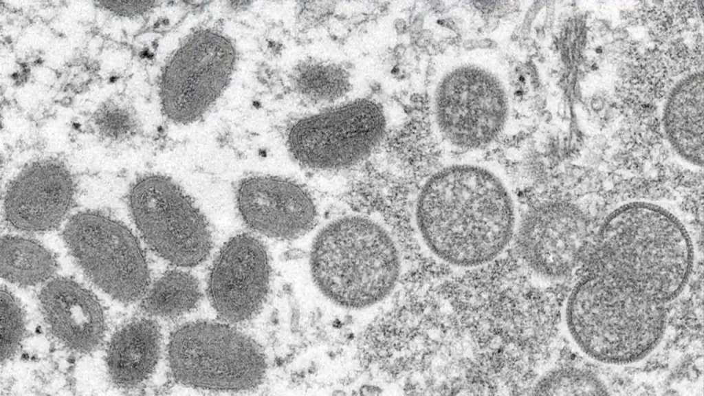 Spain Confirms 7 Monkeypox Cases as European Outbreak Grows