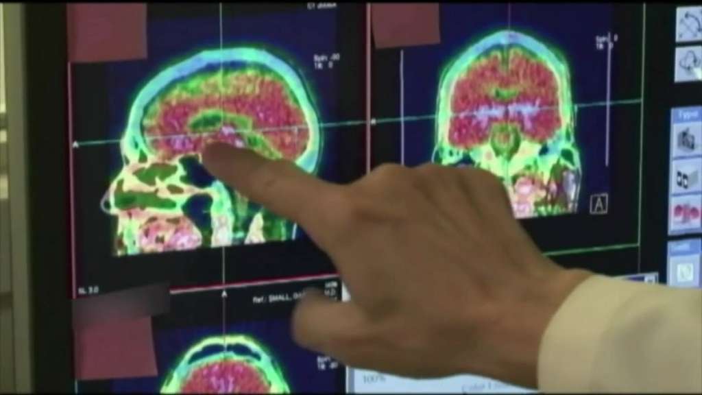 Boston University study finds CTE in over 91 percent of former NFL ...