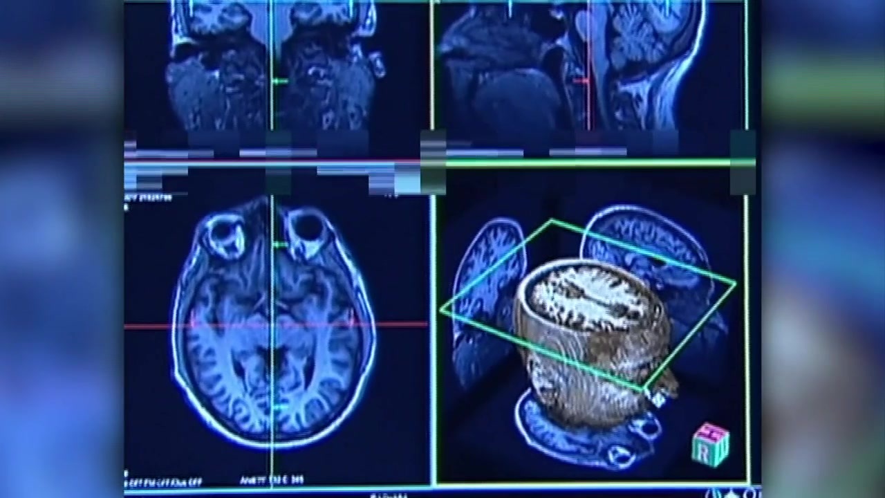 Young Amateur Athletes at Risk of CTE, BU Study Finds