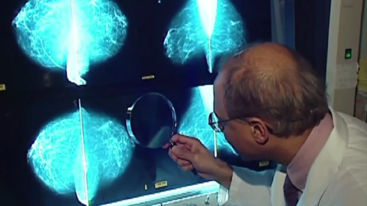 AI-supported mammogram screening increases breast cancer detection by ...