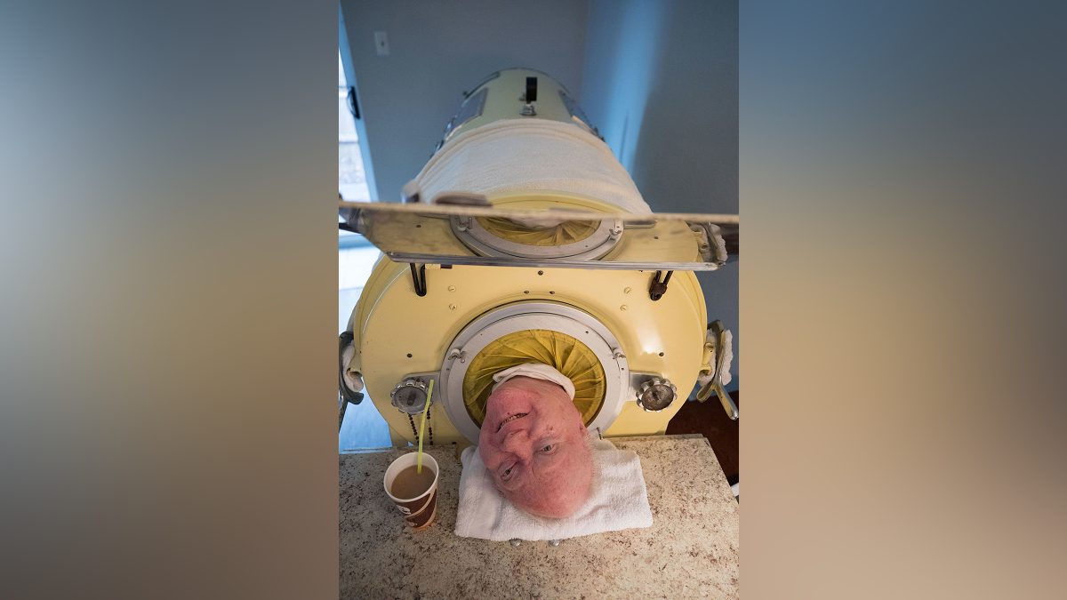 ‘Polio Paul,’ who spent most of the past 70 years in an iron lung, dies ...