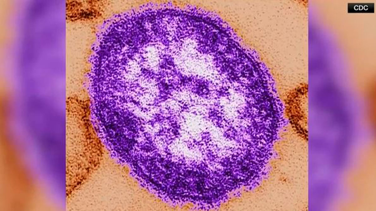 Massachusetts health officials warn of possible measles exposure in Boston, Westboro
