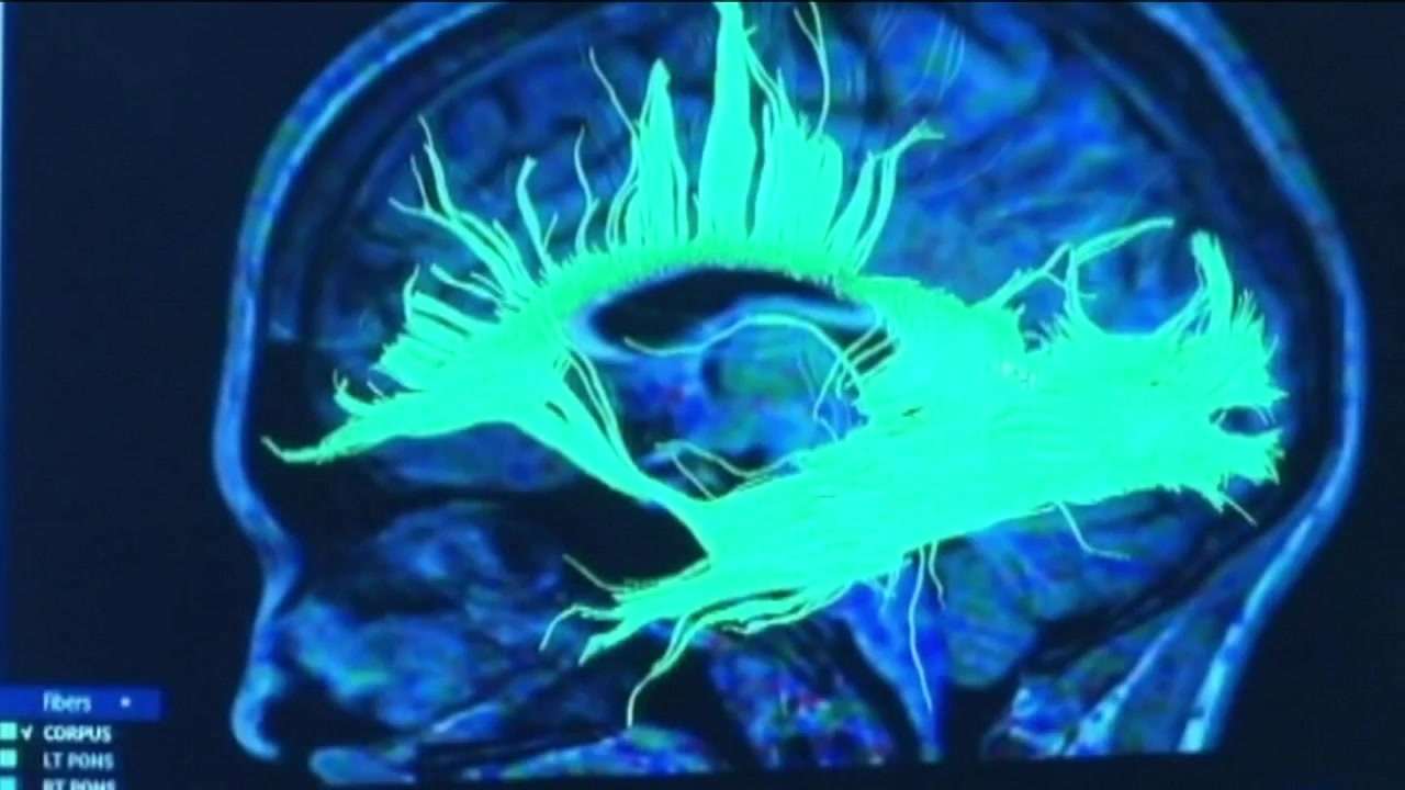 Boston University-led study estimates 75% of former NFL players who died between 2008-2023 had CTE