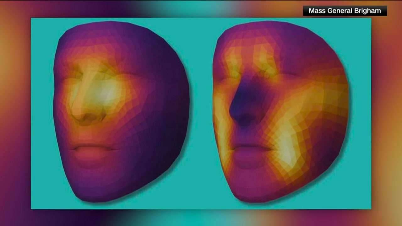 Doctors at MGB create AI models to analyze indicators of health using facial images